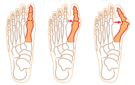 Παραμόρφωση Hallux Valgus