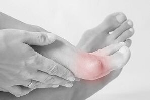 Hallux valgus πώς να επιλέξετε παπούτσια