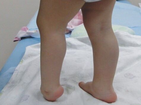Τα πρώτα συμπτώματα της παραμόρφωσης του Valgus του ποδιού
