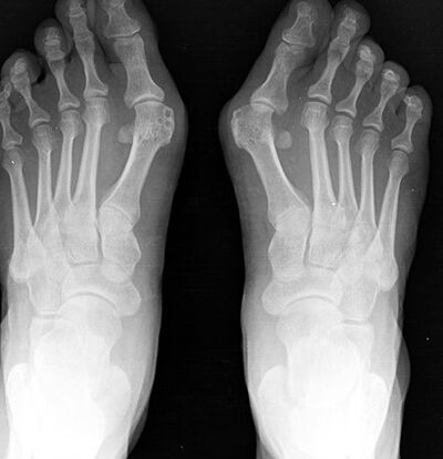 X -Ray του ποδιού