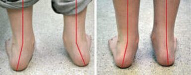 Καμπυλότητα Valgus